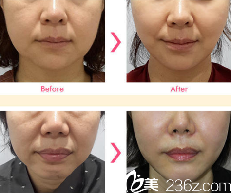 卢亨柱面部除皱案例对比图 卢亨柱面部除皱案例对比图