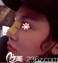 手术后一个礼拜 手术后一个礼拜