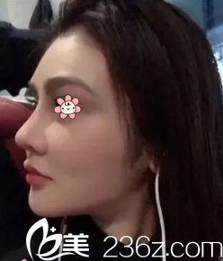 马强假体隆鼻失败修复术后19天 马强假体隆鼻失败修复术后19天