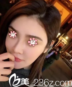 重庆赛格尔整形马强鼻修复术后两个月 重庆赛格尔整形马强鼻修复术后两个月