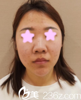 我在<!--<i data=20240703-sp></i>-->做鼻综合之前的照片 我在<!--<i data=20240703-sp></i>-->做鼻综合之前的照片