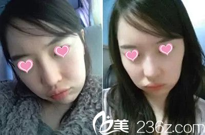 面部轮廓手术前照片 面部轮廓手术前照片