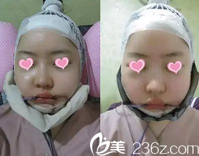 下颌角手术 下颌角手术