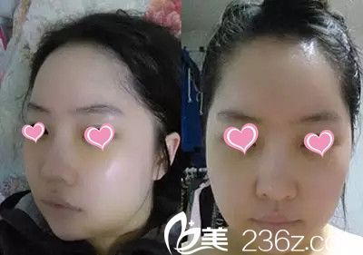 在韩国美多丽娜MEDITRINA整形医院下颌角手术后一周 在韩国美多丽娜MEDITRINA整形医院下颌角手术后一周