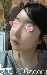 下颌角手术后半个月 下颌角手术后半个月