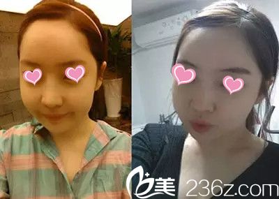 面部轮廓手术一个月后效果 面部轮廓手术一个月后效果