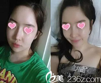 术后两个月 术后两个月