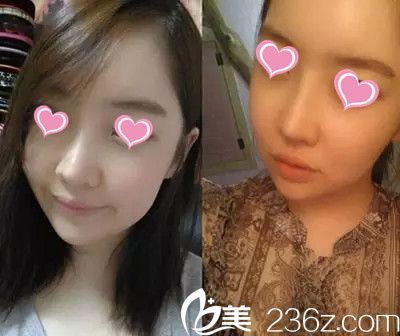 李成国院长下颌角手术案例 李成国院长下颌角手术案例