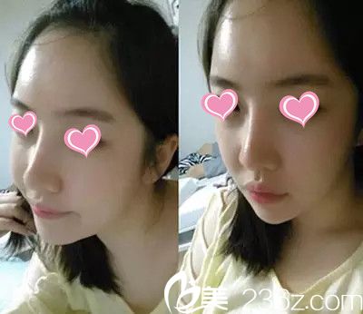 术后三个月 术后三个月