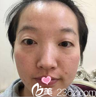在北京美莱做韩式双眼皮开眼角祛眼袋前样子 在北京美莱做韩式双眼皮开眼角祛眼袋前样子