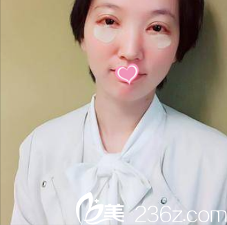 在北京美莱做韩式双眼皮开眼角祛眼袋术后即刻样子