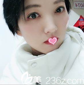 在北京美莱做韩式双眼皮开眼角祛眼袋第28天效果 在北京美莱做韩式双眼皮开眼角祛眼袋第28天效果