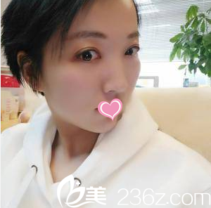 北京美莱韩式双眼皮开眼角祛眼袋案例 北京美莱韩式双眼皮开眼角祛眼袋案例