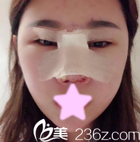 <!--<i data=20240703-sp></i>-->杨明峰给我做隆鼻后第1天照片 <!--<i data=20240703-sp></i>-->杨明峰给我做隆鼻后第1天照片