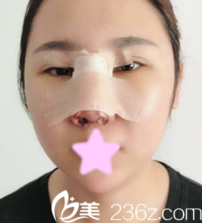 我找太原杨明峰做鼻综合术后第4天照片