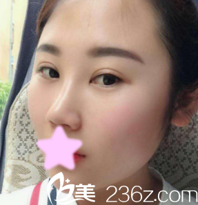 隆鼻日记：记录我找整形杨明峰做鼻综合隆鼻1-7天的恢复过程照片