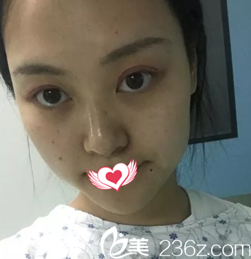 切开双眼皮3天后眼睛红肿