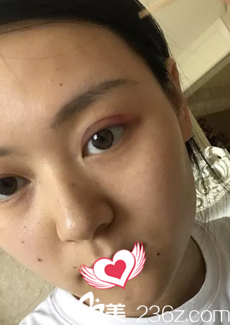 术后7天双眼皮拆线后微肿