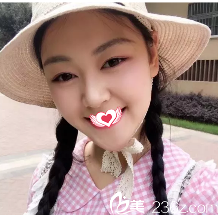 切开双眼皮16天眼睛消肿