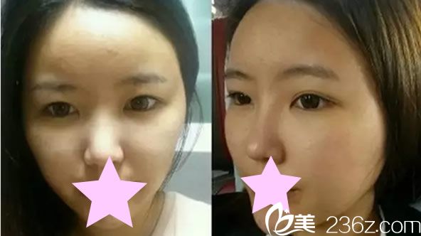 假体隆鼻手术前