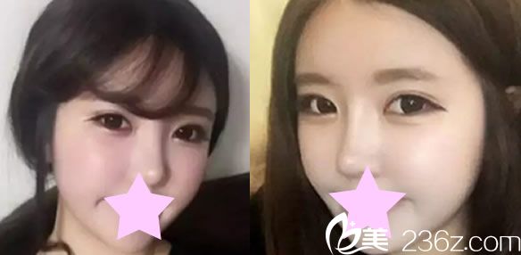 假体隆鼻术后恢复图