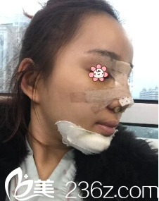 <!--<i data=20240703-sp></i>-->医生给我做完手术后第三天