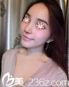 <!--<i data=20240703-sp></i>-->假体隆鼻术后18天