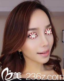 贵阳美贝尔<!--<i data=20240703-sp></i>-->假体隆鼻术后一个月