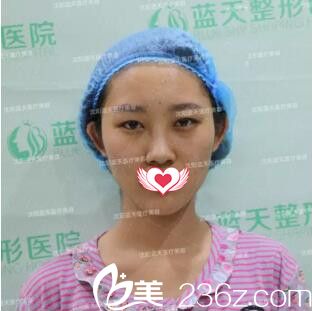 双眼皮+自体脂肪填充全脸术前照 双眼皮+自体脂肪填充全脸术前照