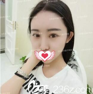 在沈阳蓝天整形医院一口气做了双眼皮+自体脂肪填充全脸后效果竟然超出我的意料！
