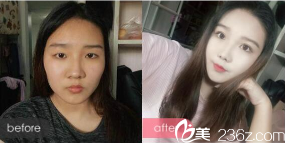 广州荔医整形医院李增产做的双眼皮案例 广州荔医整形医院李增产做的双眼皮案例