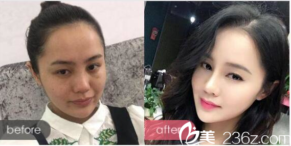 广州荔医整形医院李增产做的隆鼻案例 广州荔医整形医院李增产做的隆鼻案例