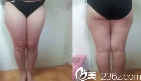 兰州韩美整形美容大腿吸脂前 兰州韩美整形美容大腿吸脂前