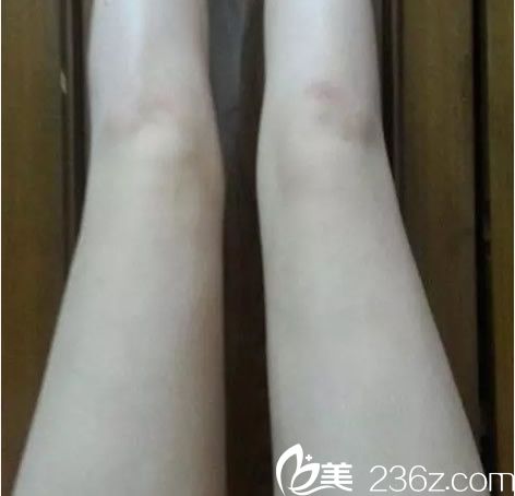 兰州韩美吸脂瘦大腿四个月后恢复效果