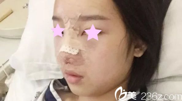 韩美鼻综合隆鼻天 韩美鼻综合隆鼻天