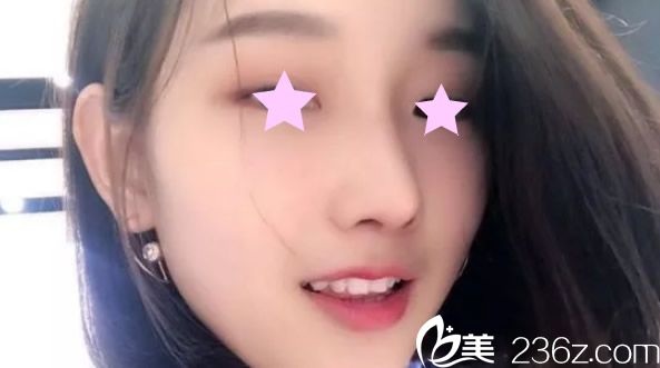 韩式生科隆鼻+耳软骨垫鼻尖第20天效果 韩式生科隆鼻+耳软骨垫鼻尖第20天效果