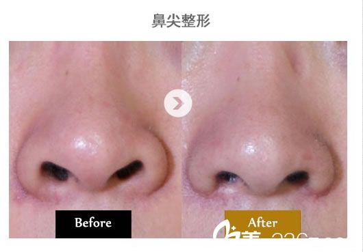鼻头鼻尖整形对比图 鼻头鼻尖整形对比图