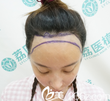 广州荔医整形美容医院植发术前 广州荔医整形美容医院植发术前