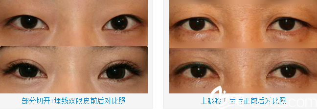 南荣午院长双眼皮案例 南荣午院长双眼皮案例