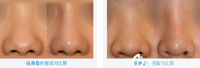 韩国JH整形医院南荣午隆鼻案例 韩国JH整形医院南荣午隆鼻案例