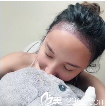 在广州荔医种植发际线天 在广州荔医种植发际线天