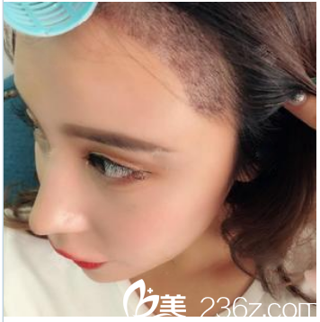 在广州荔医种植发际线术后半个月 在广州荔医种植发际线术后半个月