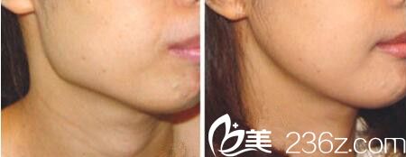下颌角整形前后对比效果