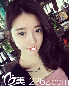 南荣午全切双眼皮修复术后半个月 南荣午全切双眼皮修复术后半个月