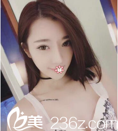 重睑线消失变一单一双，幸好韩国JH整形医院南荣午做埋线双眼皮修复给我弄好了。