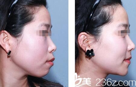 真人突嘴矫正+下颌缩短整形前后对比效果 真人突嘴矫正+下颌缩短整形前后对比效果