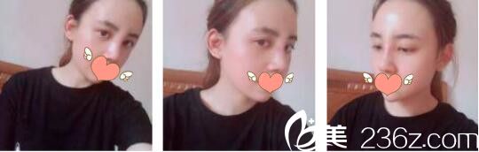 韩国WELLS整形外科李秉夏线雕鼻取出+鼻综合真人案例术后第七天