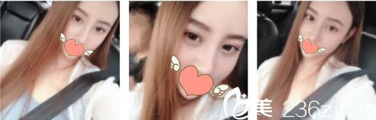 韩国WELLS整形外科李秉夏线雕鼻取出+鼻综合真人案例术后一个月