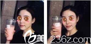 上海伊莱美医疗美容医院任建新超皮秒祛斑真人案例术后十五天