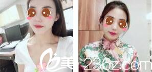 上海伊莱美医疗美容医院任建新超皮秒祛斑真人案例术后一个月